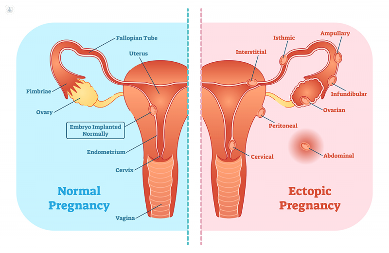 What is the Difference between Miscarriage And Ectopic Pregnancy